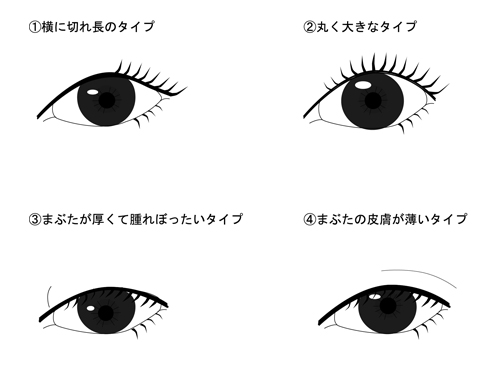 まぶたタイプから見る二重術