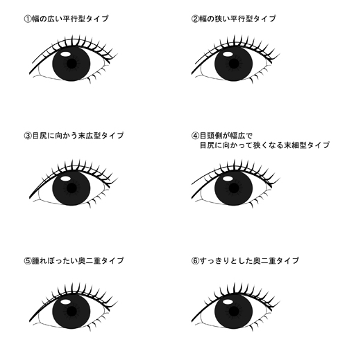 まぶたタイプから見る二重術